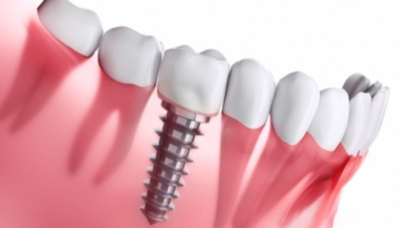 Restorative Dentistry in Hamilton, GA, is Available to Help With Damaged Teeth