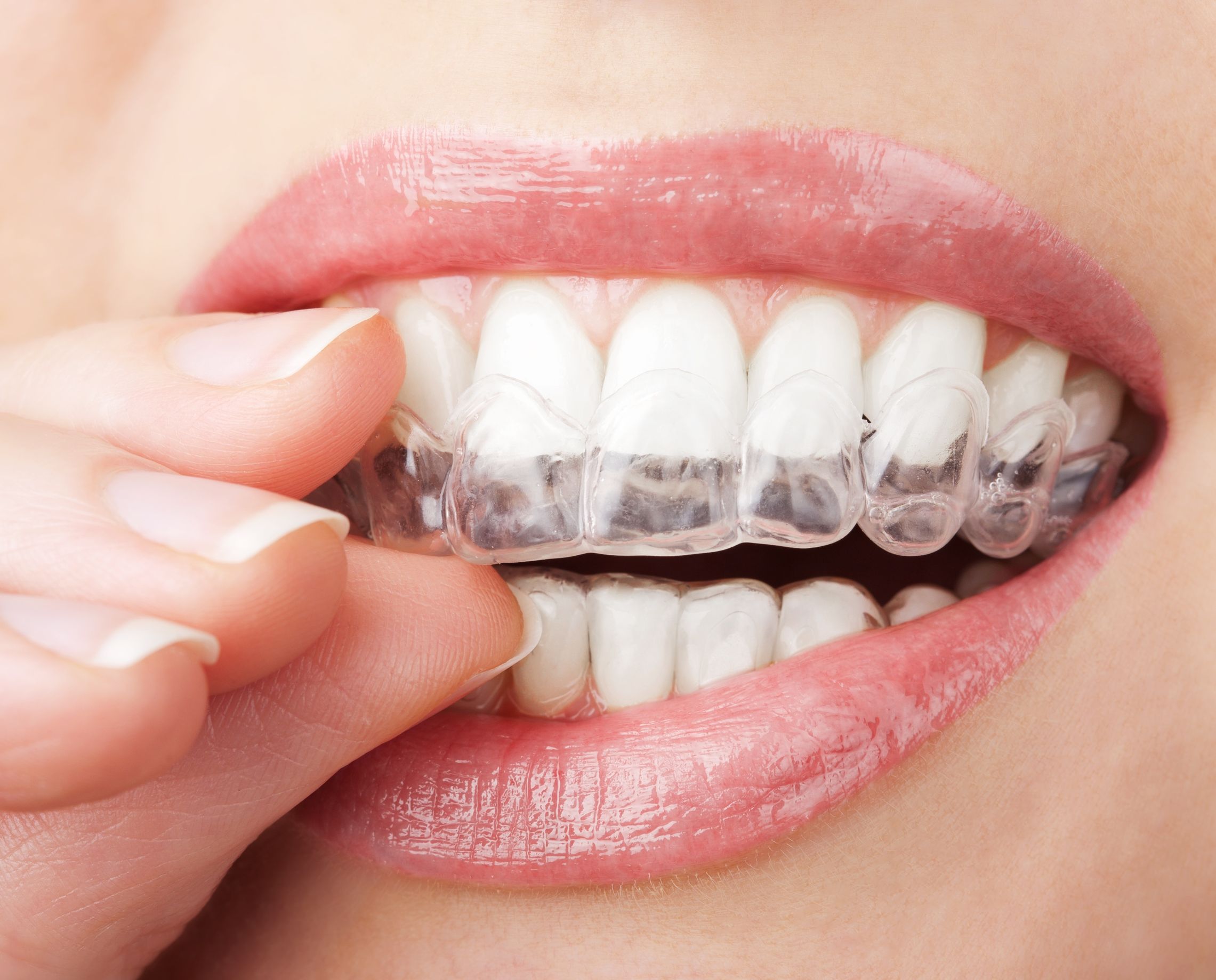 Details About Invisalign Braces In O’Fallon, MO