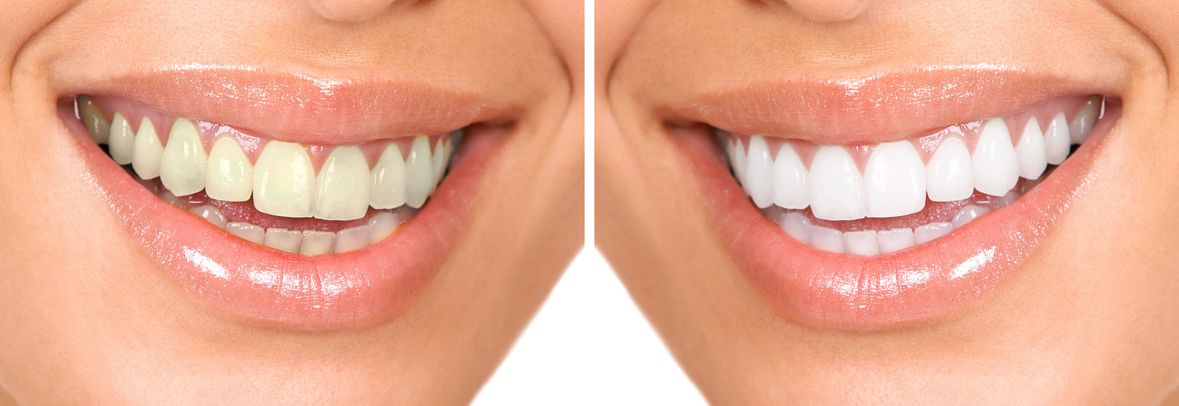 Top-Notch Teeth Whitening in Kennewick Is Often a Service Provided By General Dentists