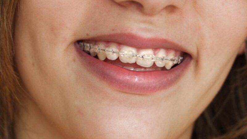 Trust Your Smile To The Professionals At Orthodontics In Medina OH